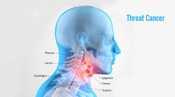 Throat cancer symptoms homeopathic treatment signs nose causes eposts effective advertisement disease understand progression